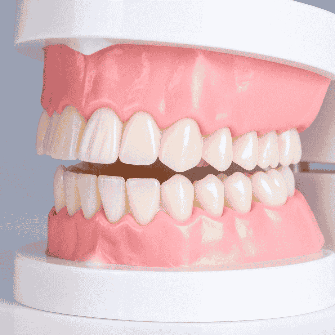 dental implants in Mohali